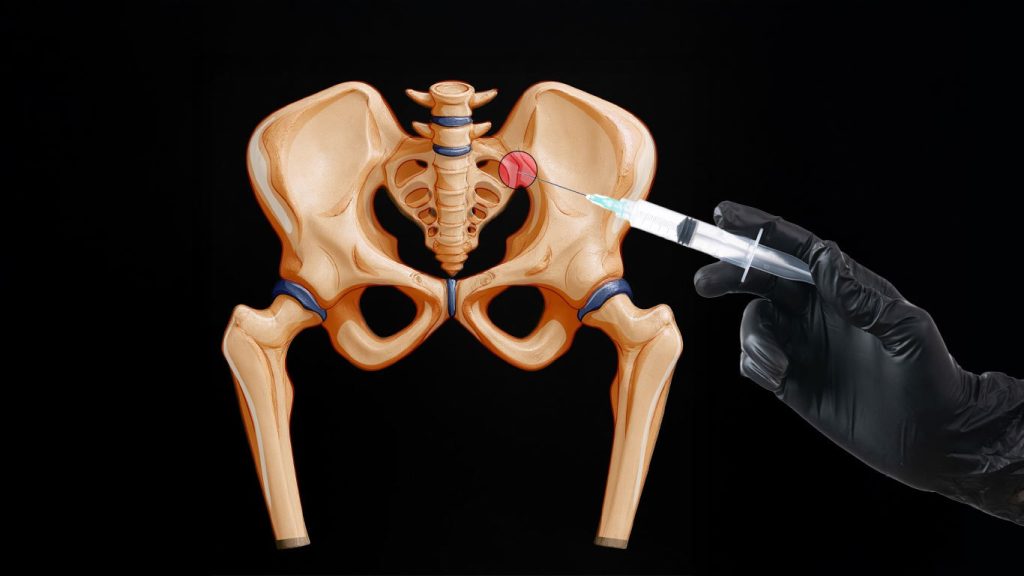 Sacroiliac Joint Injections Phoenix