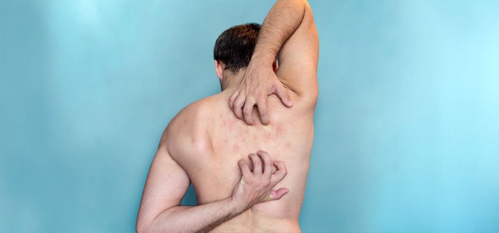 Postherpetic Neuralgia Treatment Phoenix