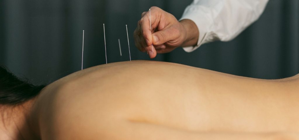 Acupuncture in Phoenix